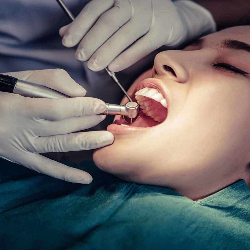 Dental-filling