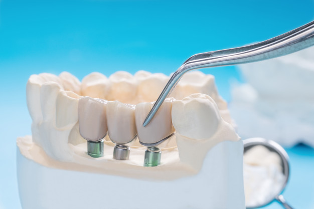 close-up-implan-model-tooth-support-fix-bridge-implan-crown_60829-541