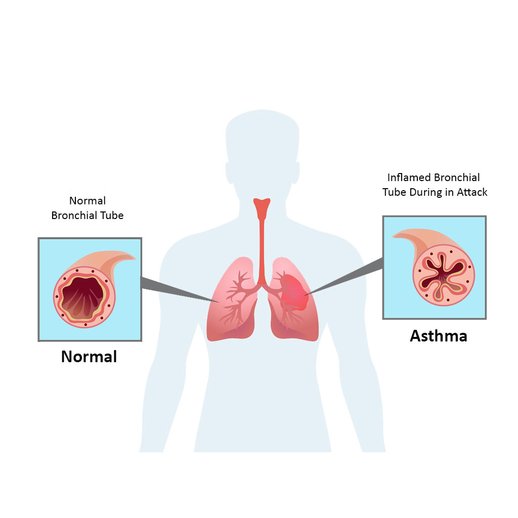 Asthma Management In Child – TISYA CLINICS